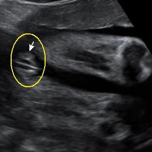2d_ultrasound_scan_image_girl_2